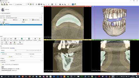 dicom to stl 3d slicer|DICOM to STL Conversion Tutorial with Segment Editor .